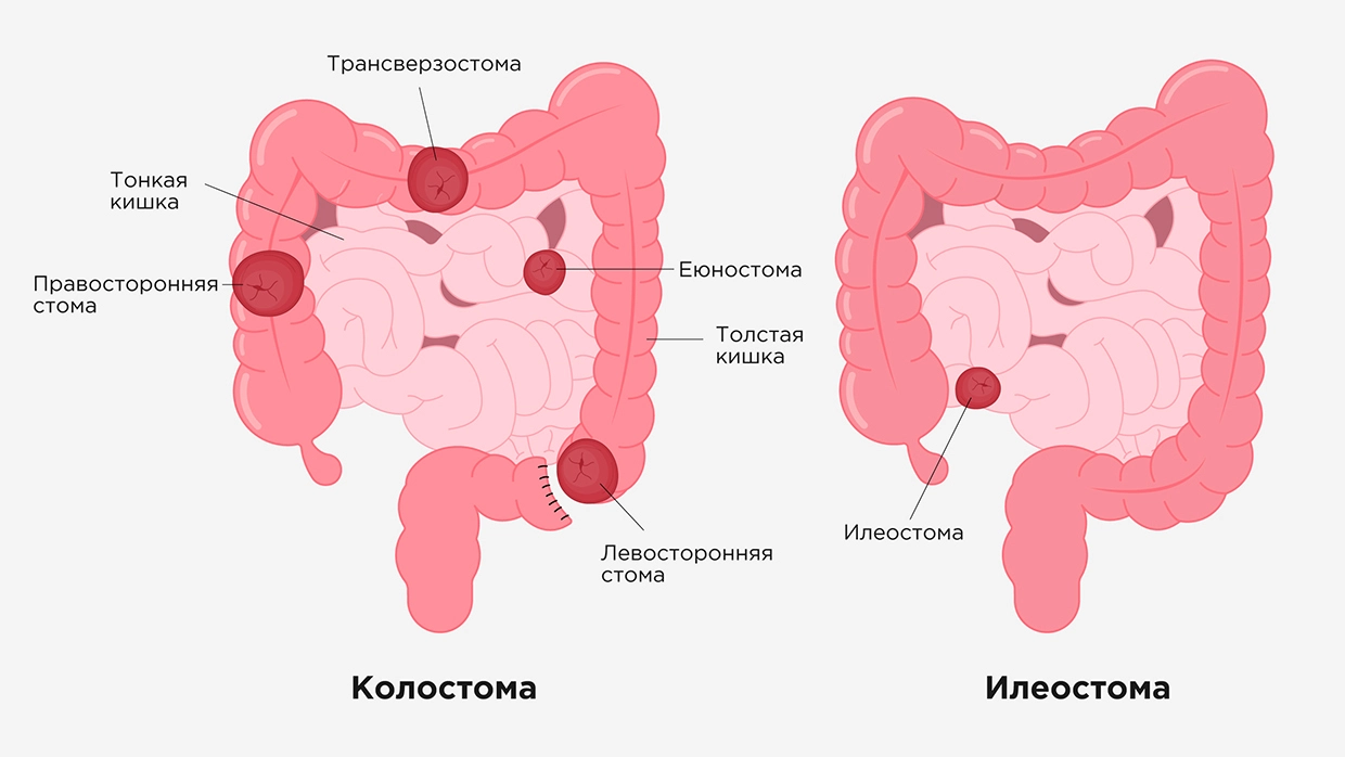 Недостаточность анального сфинктера у взрослых. Клинические рекомендации.